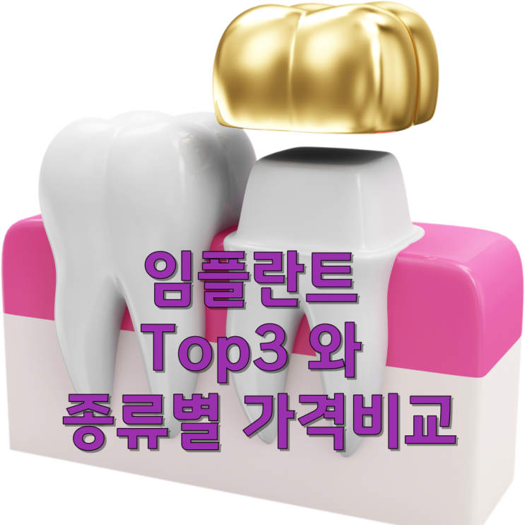  임플란트 TOP3 와 종류별 가격비교