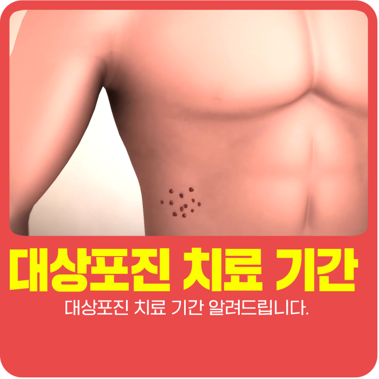  대상포진 치료 기간 알려드립니다.