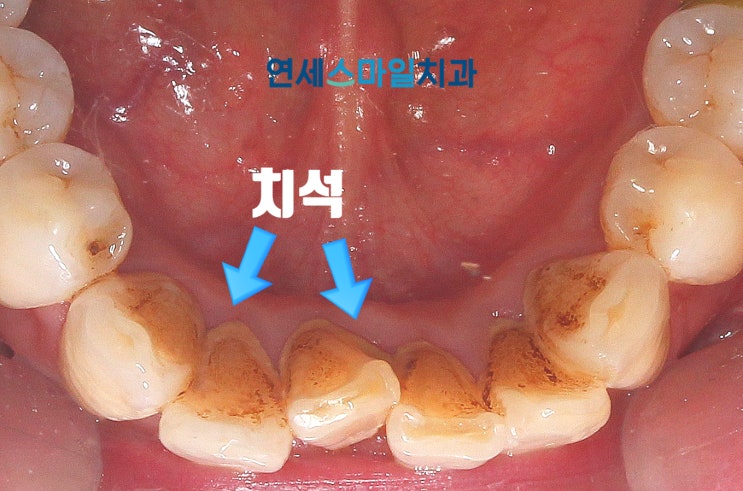  2023 스케일링 보험 비용/주기/대상자 정리 (노원치과)