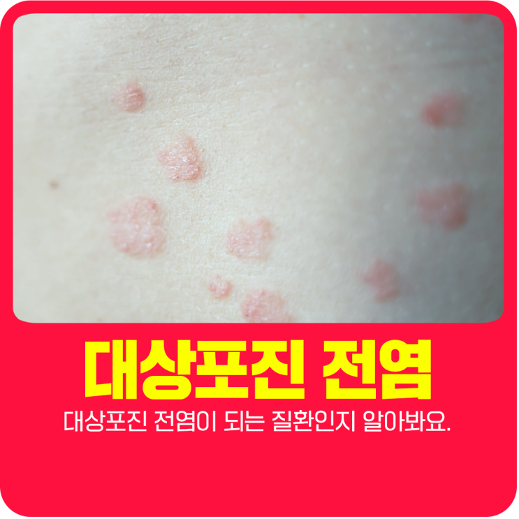  대상포진 전염이 되는 질환인지 알아봐요.