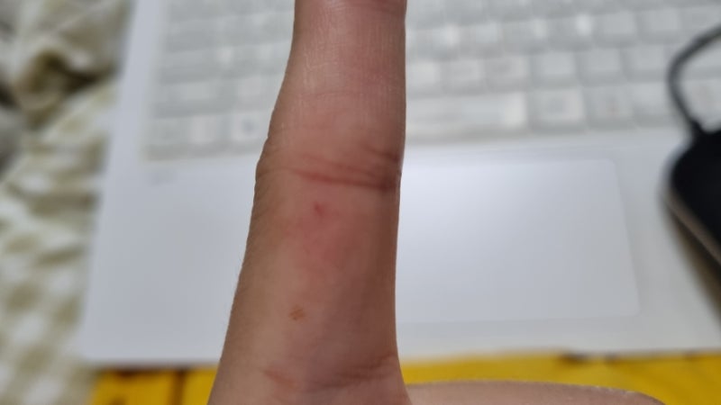 주사침 자상(주사기 찔림사고) 예방/응급처치/대처방법 : 네이버 블로그