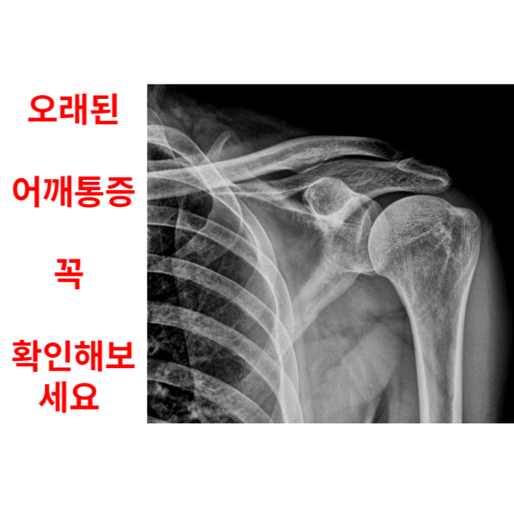  광주어깨병원, 통증이 오래되었다면 확인해 보세요