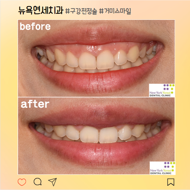  [강남역 잇몸성형] 거미스마일 보톡스 맞았는데 효과가 없다면? 후기를 통해 알아보는 구강전정술 효과