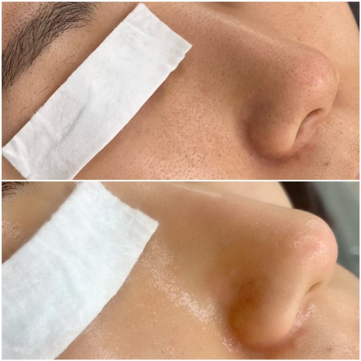  굴포천역 비채움뷰티어겐 Before After 피부관리맛집