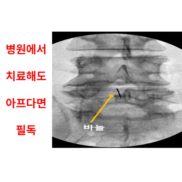  광주허리디스크, 병원에서 치료해도 아파요