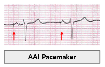 인공 심박동기 (permanent pacemaker) 개념과 해석 총정리, mode DDD, VVI, AAI와 PPM, TPM ...
