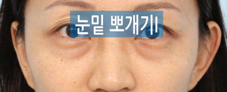  #43.눈밑뽀개기I.원인편(눈밑 꺼짐 주름 지방 처짐,다림질,재배치,제거,필러,울트라콜200)