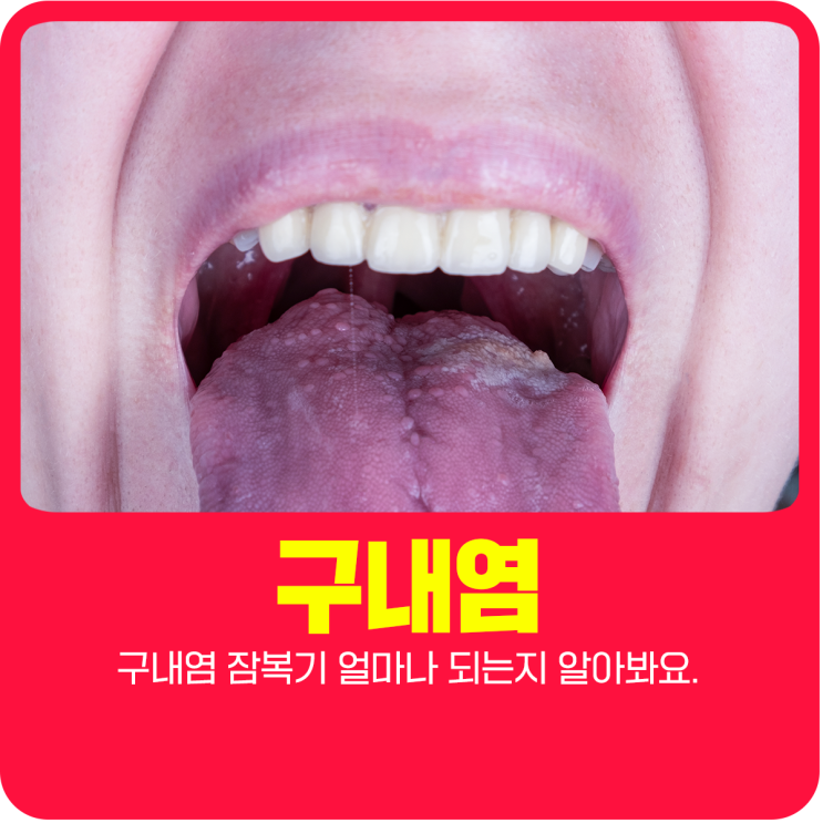  구내염 잠복기 얼마나 되는지 알아봐요.