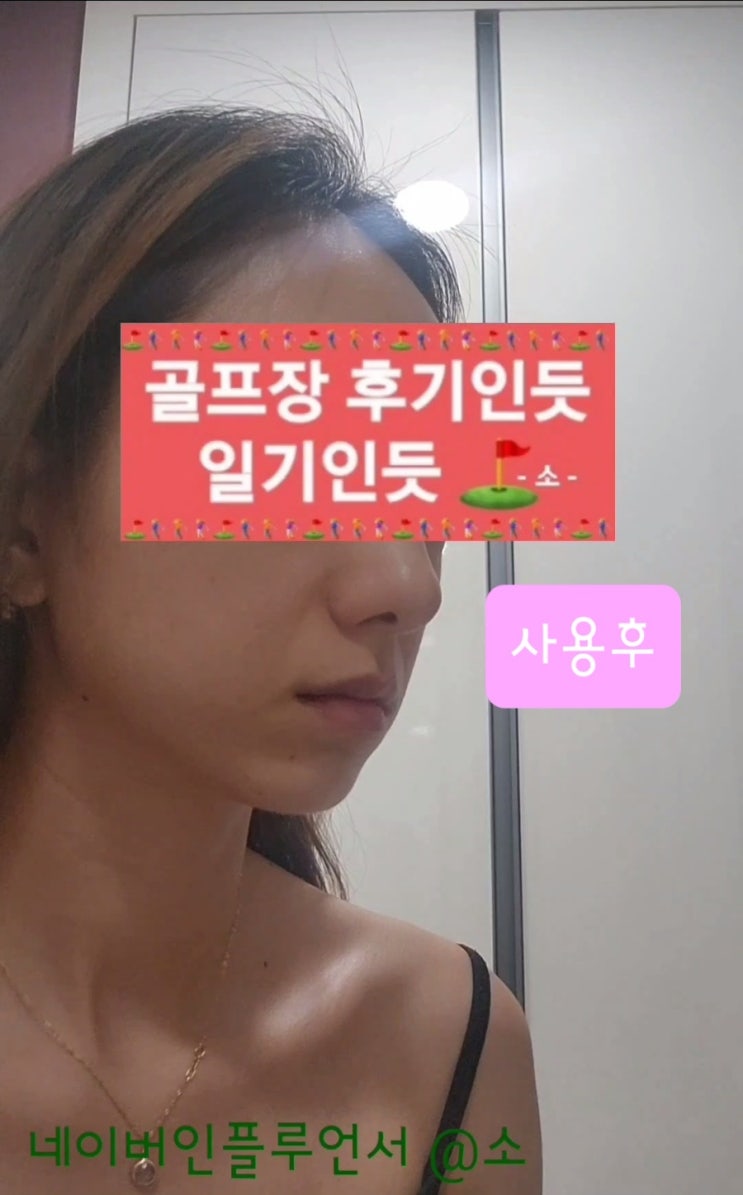  시술수술없이 간단하게 콧대세우기 코교정기 추천( PRM 투명코뽕 )