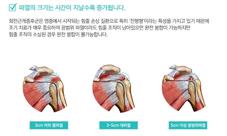 어깨 힘줄 끊어짐 회전근개파열 증상과 수술 방법 : 네이버 블로그
