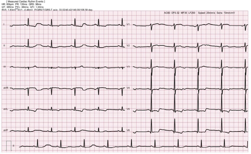 심전도 V4-V5, I, aVL leads ST segment depression and T wave inversion → ...