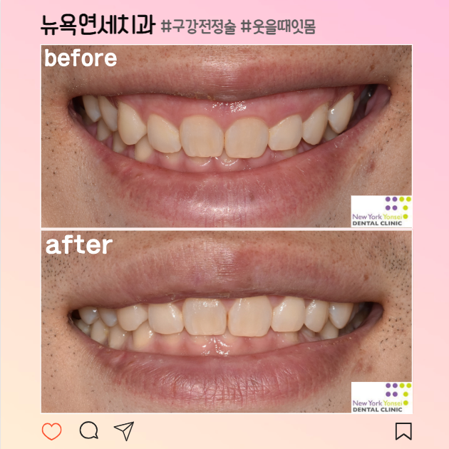  [강남역 잇몸성형] 교정으로 해결되지 않은 거미스마일, 구강전정술로 해결한 후기