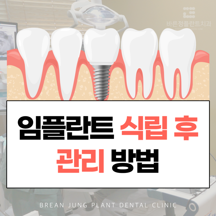  덕천역치과 임플란트 식립 후에도 관리는 철저하게!