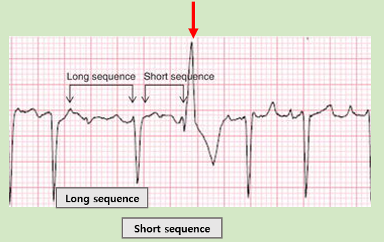 심방 조기수축 (Premature Atrial Contraction/ Complex, PAC, APC) 의학용어 심방 조기 박동 ...