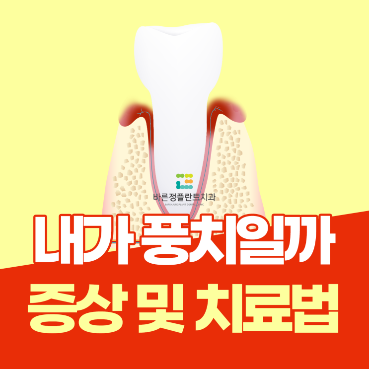  덕천동치과 풍치 초기 증상 및 치료방법 알려드릴게요
