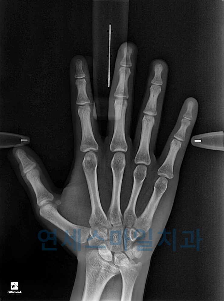  치아교정시기 성장판검사로 최적의 시기를 찾자