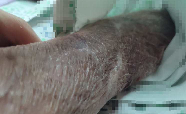 &lt;웰더스 방문간호&gt; 방문상담사례 : 장기간 억제대 사용으로 인한 피부 손상