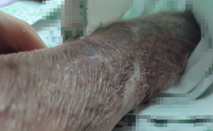  <웰더스 방문간호> 방문상담사례 : 장기간 억제대 사용으로 인한 피부 손상