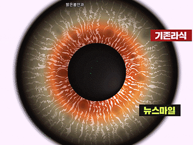  부산스마일라식 스마트라식 라식 유명한곳 부산안과추천