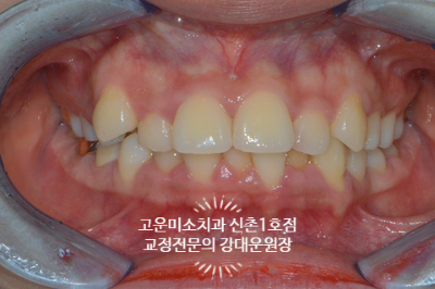  과개교합 덧니와 치열불규칙 돌출을 동반한 2급부정교합치료 신촌교정치과 고운미소치과 신촌1호점 치료증례