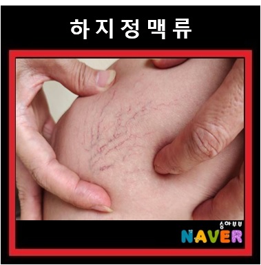  하지정맥류 초기증상 원인 및 하지 정맥류 치료 검사 예방