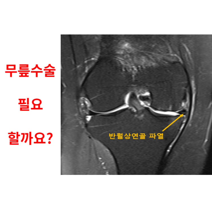  광주병원, 반월상연골파열 무릎 수술 필요할까요?