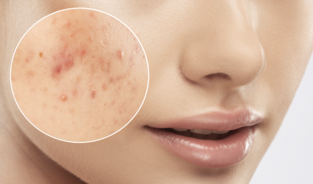  여드름 기본정보::종류 원인 화이트헤드 블랙헤드 염증성 낭종 결절성 켈로이드성...acne vulgaris