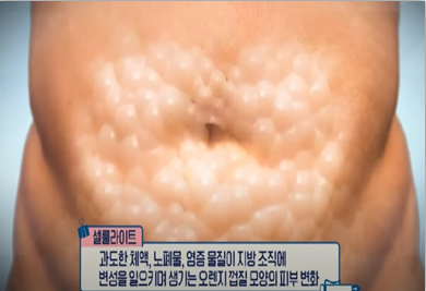 셀룰라이트는 지방처럼 운동으로 태울수 없다
