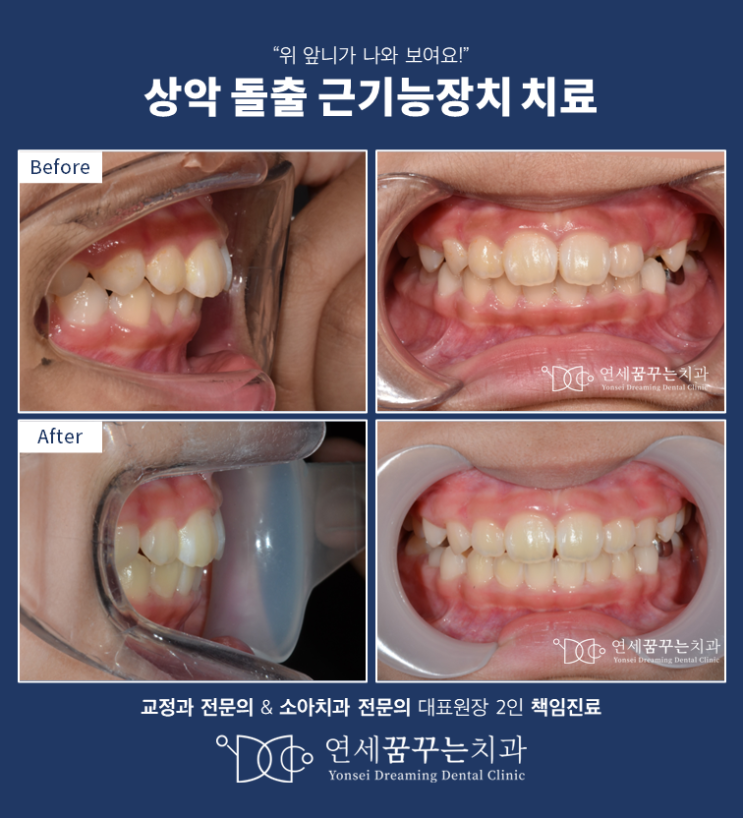 돌출과 과개교합 어린이에서 프리올소로 돌출 개선, 교합 개선 돌출과 과개교합 어린이에서 프리올소로 돌출 개선, 교합 개선