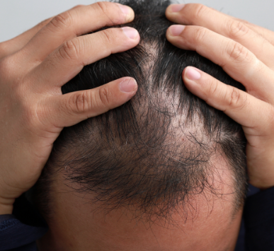 탈모 기본정보::종류 원인 남성 여성 원형 비강성 결발성 악성 모발주기 두피...Hair loss