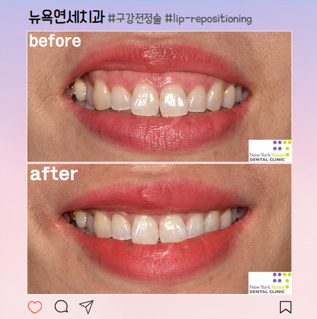  [강남역 잇몸성형] 보톡스로 해결되지않는 거미스마일, 구강전정술로 해결! (feat.입술재배치술, lip repositioning)