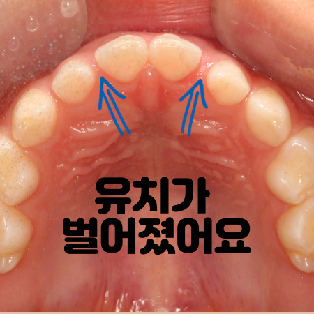  아기 유치 벌어짐 치료가 필요할까요 지켜봐도 되나요?