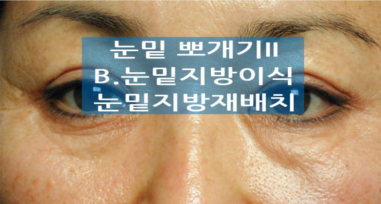 #45.눈밑뽀개기II.치료편B.지방이식,눈밑지방재배치(눈밑 꺼짐 주름 지방)