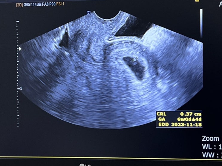 임신 극초기 증상, 임신 5주차, 6주차(아기집, 심장소리 확인)
