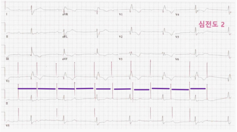 심전도, High grade AV block, Complete AV block, AF with complete heart ...