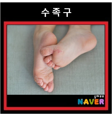  아기 수족구 증상 원인 전염 수족구병 치료 및 예방