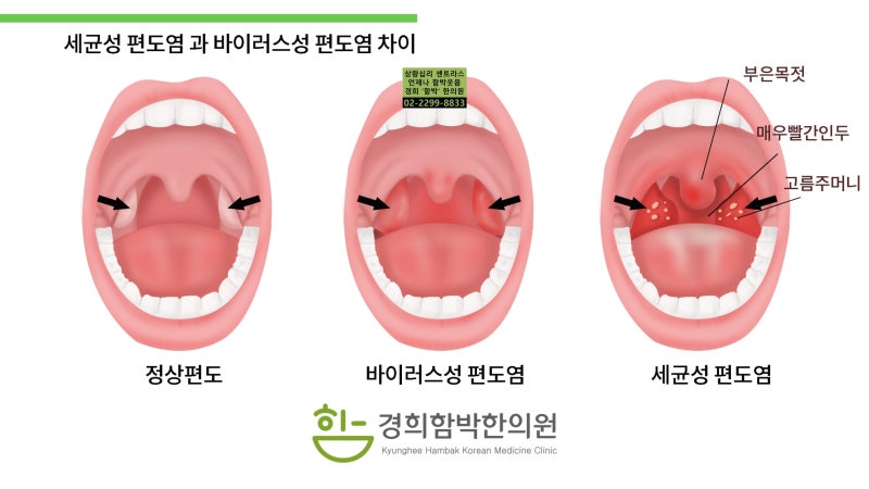 인후통, 두통, 급성상기도감염, 감기증상, 편도염의 원인