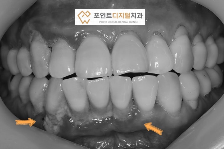  [탕정치과] 앞니가 흔들려서 발치(발치즉시 임플란트, 브라이트)