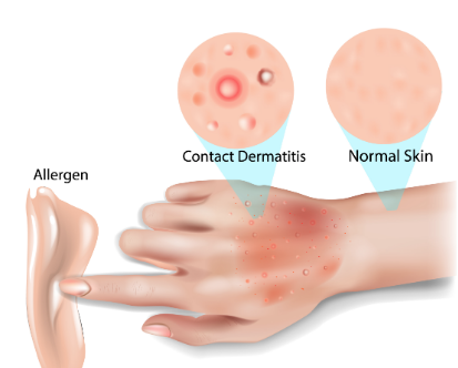  피부염 기본정보::종류 원인 피부질환...아토피 접촉성 지루성 감염성 알레르기 습진 dermatitis