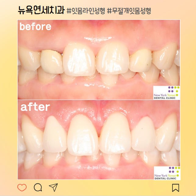  [강남역 치과] 치아교정으로 해결되지않은 짧고 답답한 치아, 무절개 잇몸성형으로 해결!(feat.거미스마일)