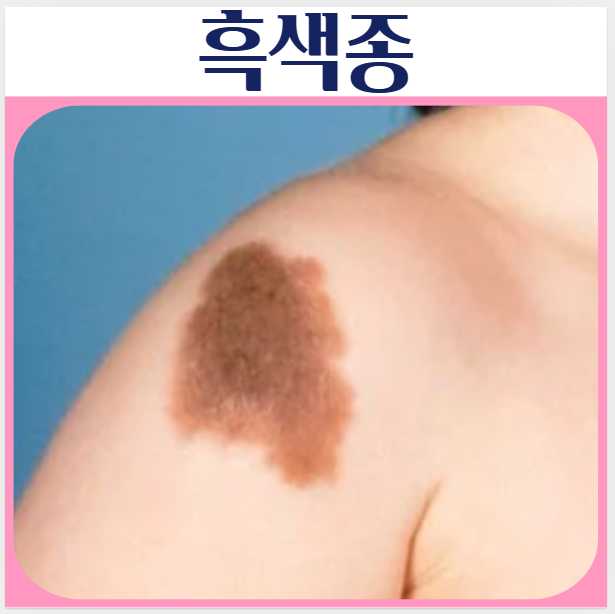 피부에 검은색 점? 흑색종 피부암 발생부위 유형 악성 증상