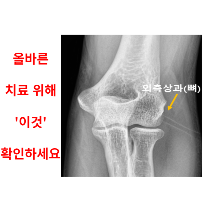  광주테니스엘보, 올바른 치료가 필요합니다