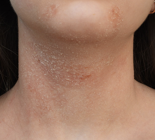  아토피 피부염 기본정보::증상 원인 정의 질환...피부장벽 면역 환경 유전 알레르기 atopy