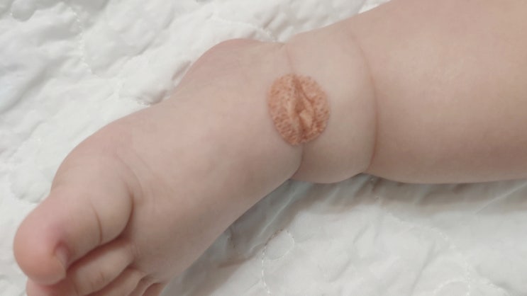  돌잔치 그 후 끝나지 않은 이야기 : 돌아기 고열로 응급실행