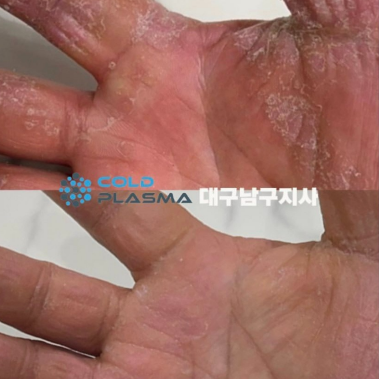  대구 콜드플라즈마 악성 손건선으로 인한 각질 가려움 해결하기!