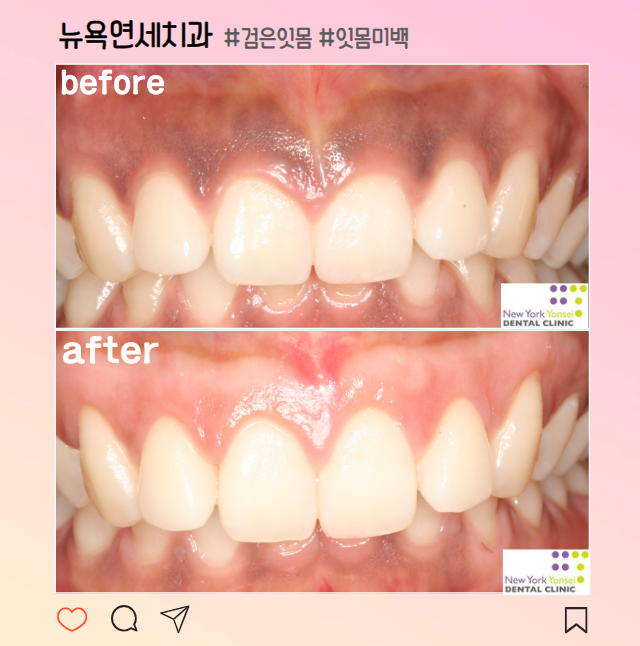 [강남역 치과] 검은색 잇몸 미백으로 해결!