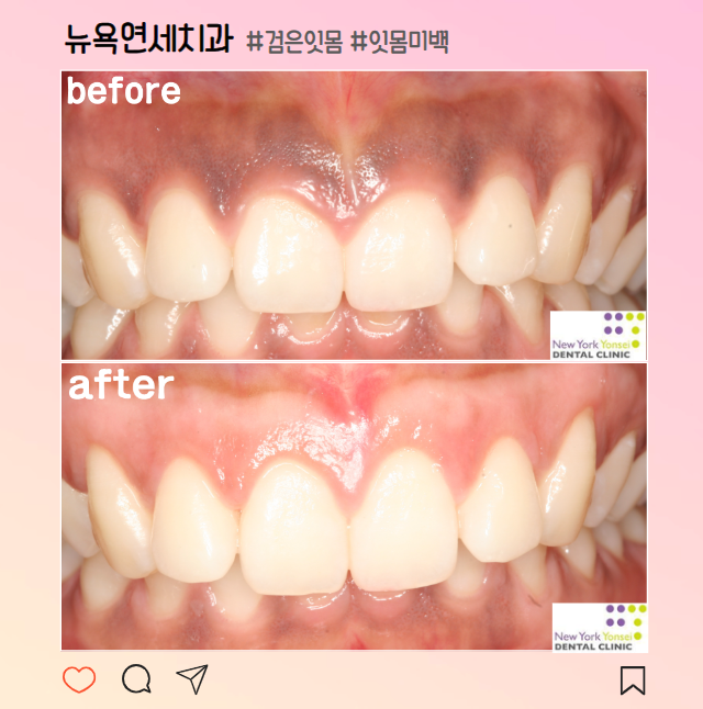  [강남역 치과] 검은색 잇몸 미백으로 해결!