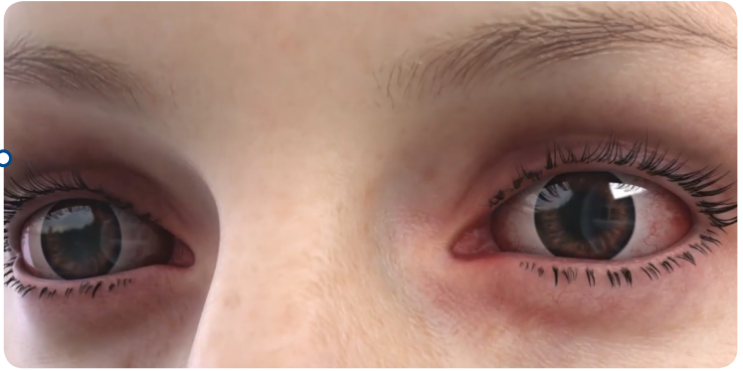  The Effectiveness of Temporary Collagen Punctal Plugs for Dry Eye Disease Treatment