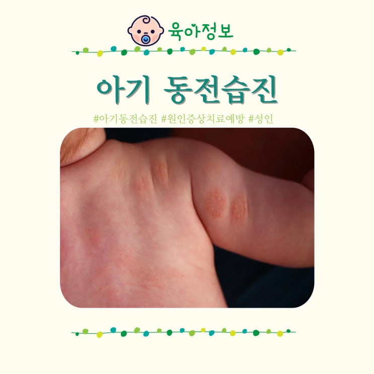  아기 동전습진 원인 연고 비판텐 리도맥스 0.3 병원 로션