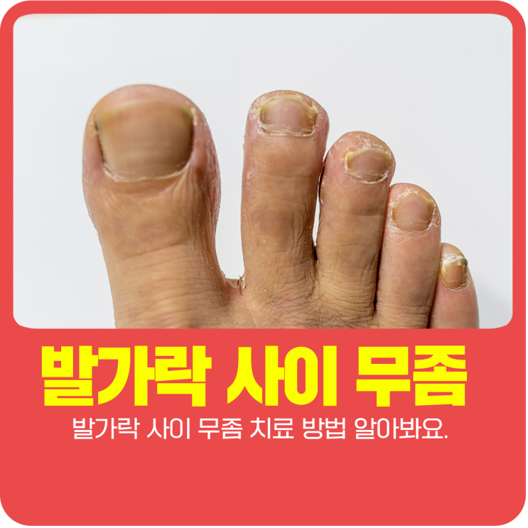  발가락 사이 무좀 치료 방법 알아봐요.